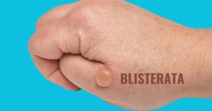 Blisterata